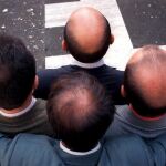 La alopecia está entre las enfermedades autoinmunes humanas más comunes